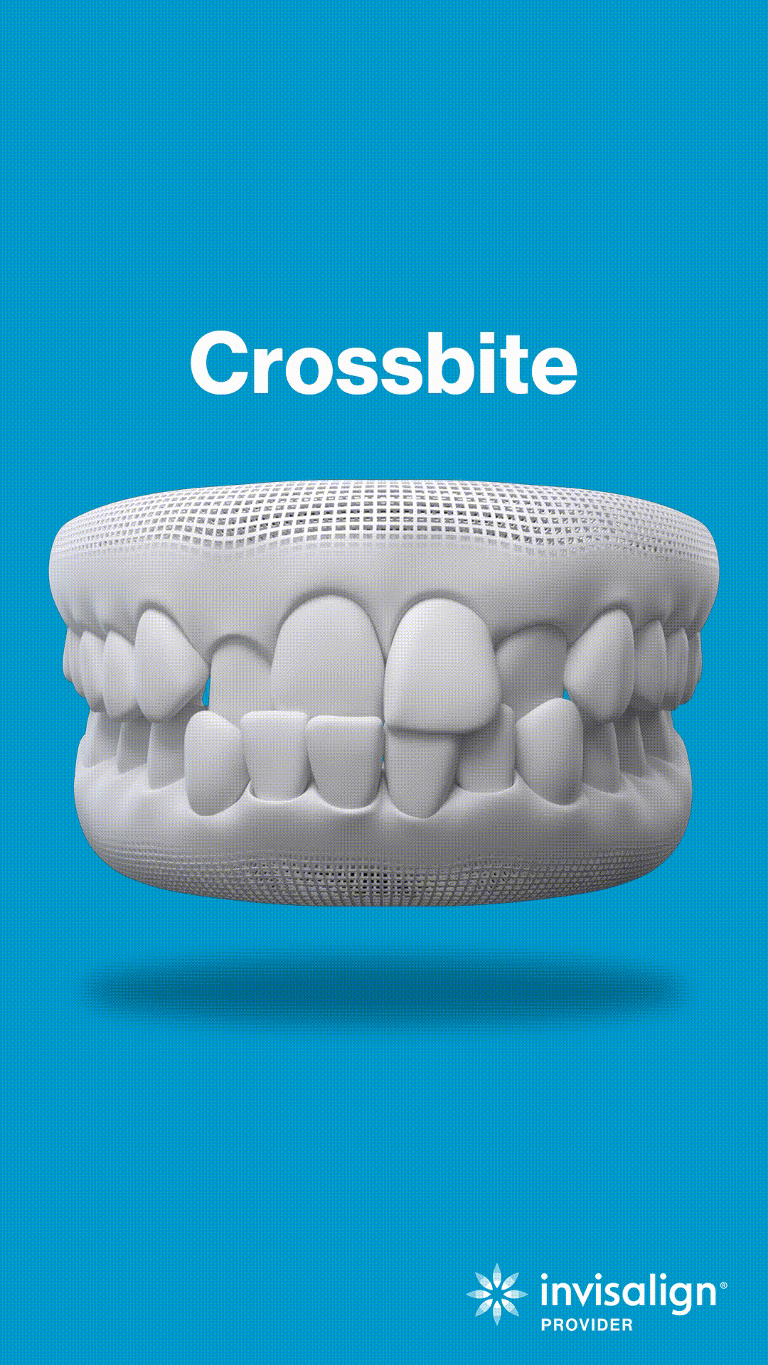 Crossbite dental model showing misaligned teeth on blue background for orthodontic treatment education.