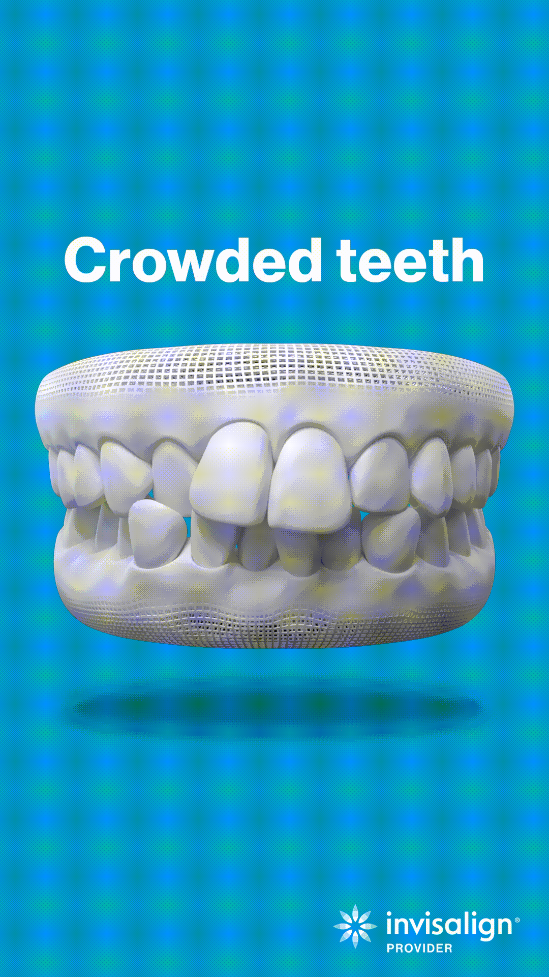 3D dental model showing crowded teeth malocclusion on blue background with Invisalign branding.