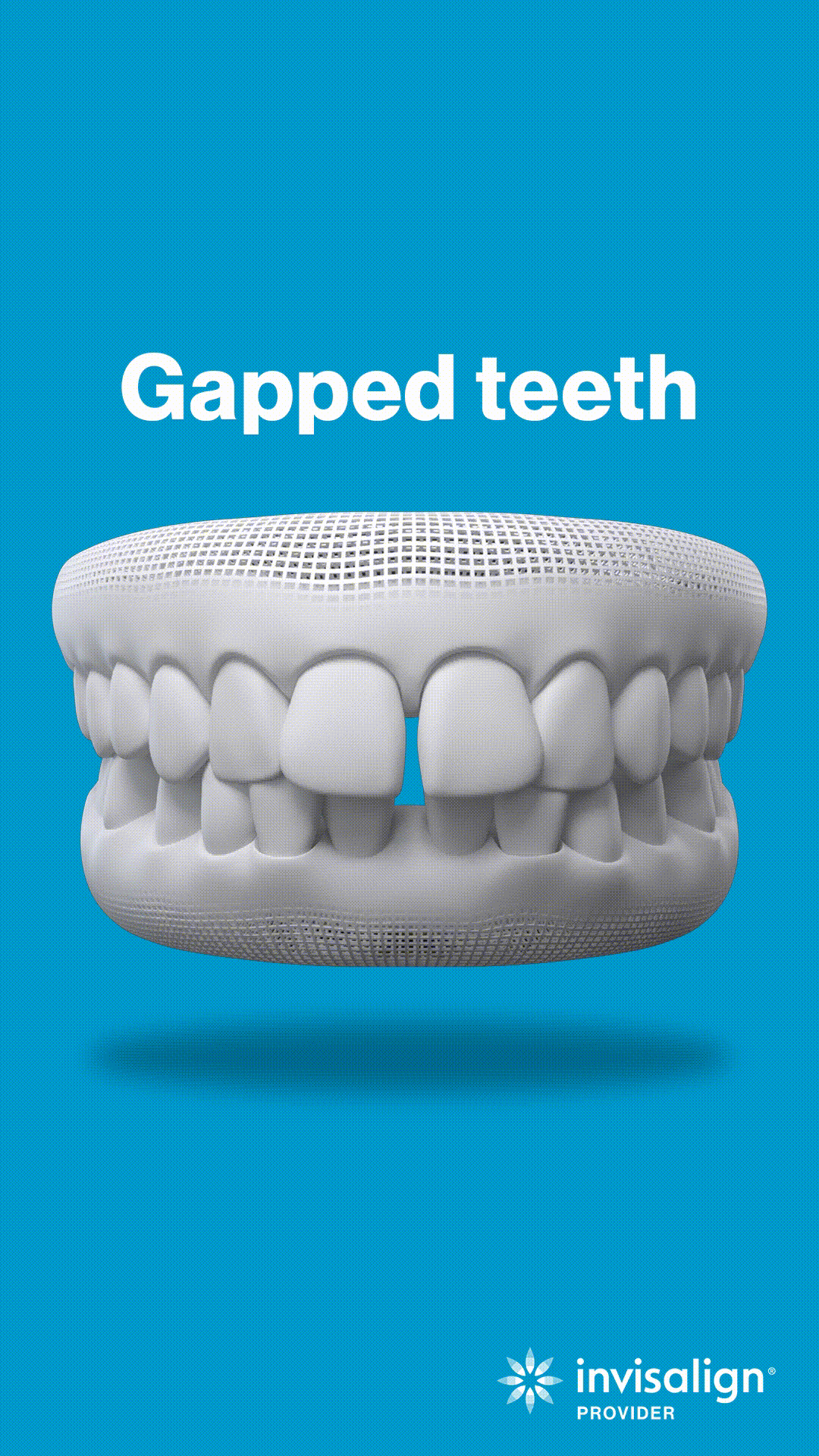Dental model displaying gapped teeth with blue background and Invisalign branding for orthodontic treatment.
