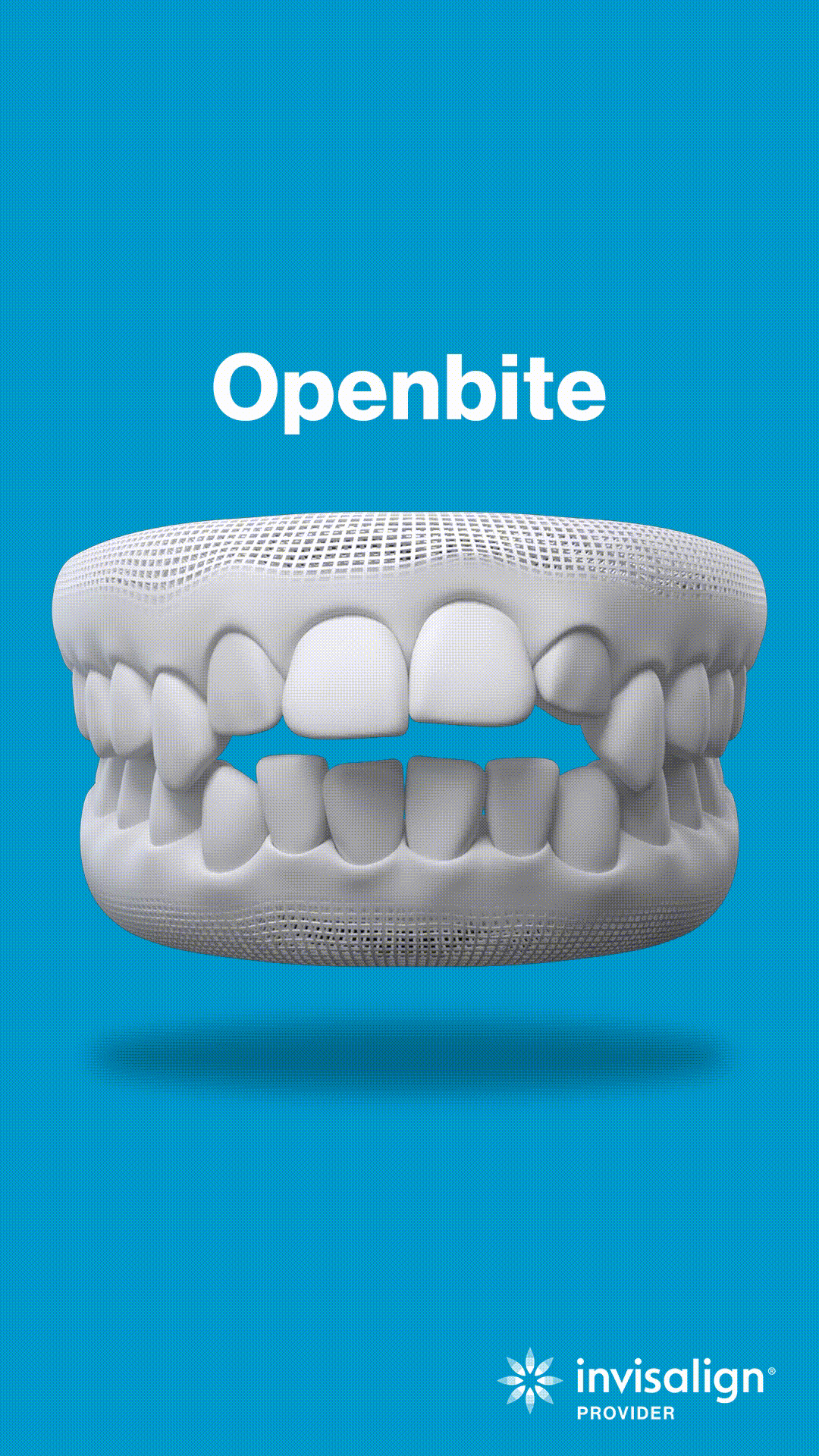 Openbite dental model showing teeth misalignment on blue background with Invisalign logo.