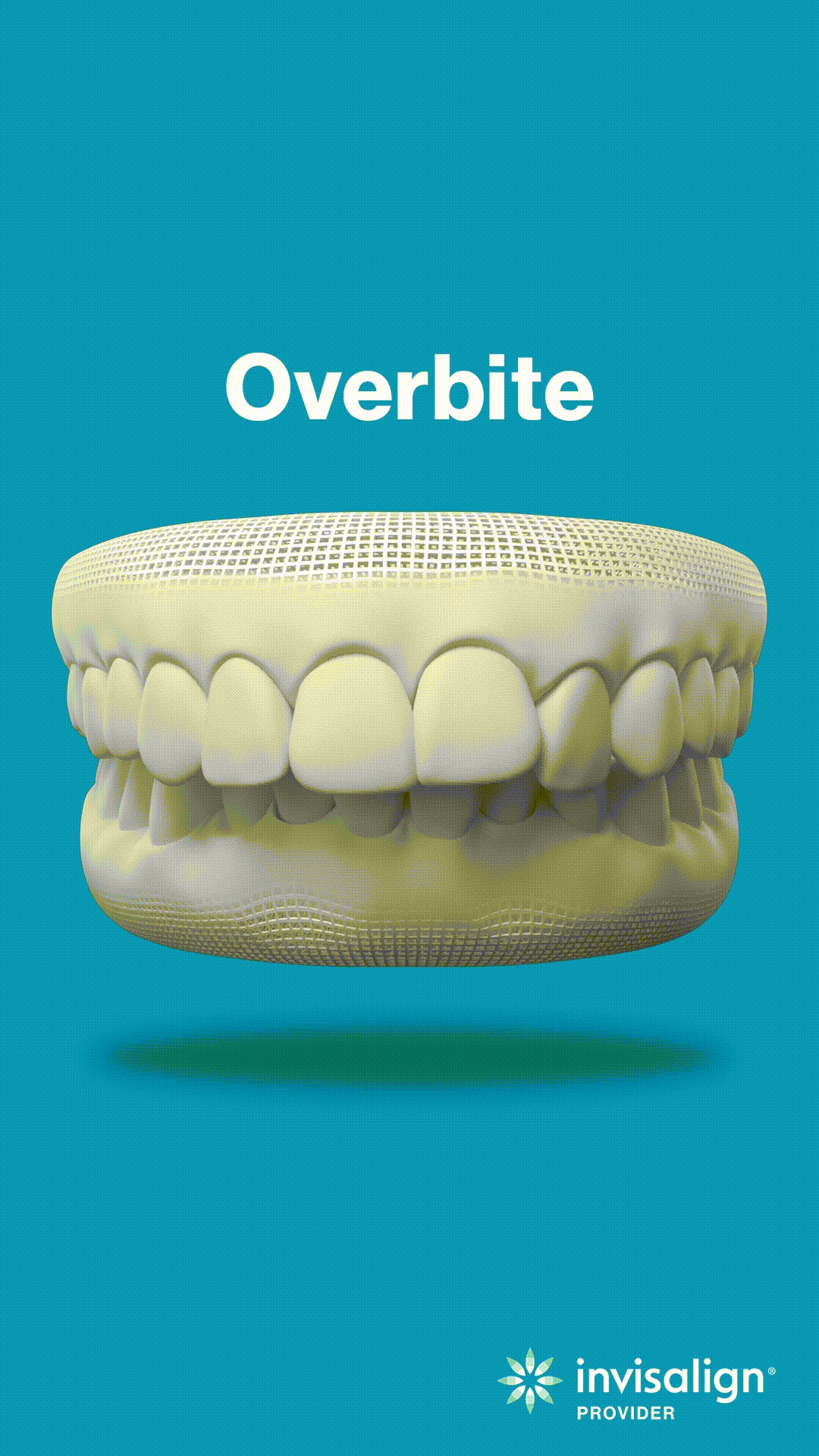 3D dental model showing overbite malocclusion on blue background with Invisalign branding