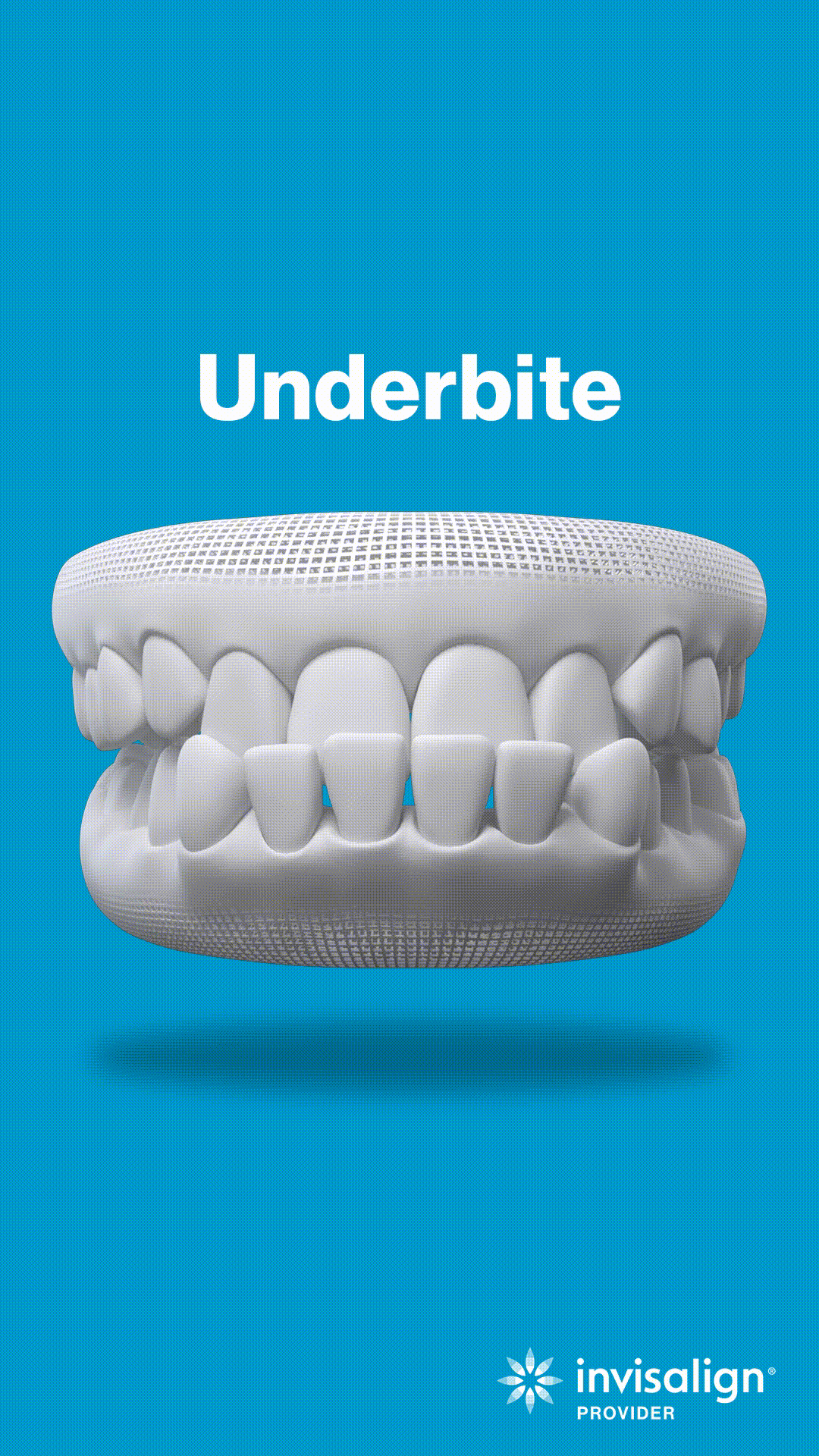 3D dental model showing underbite malocclusion against blue background with Invisalign branding.