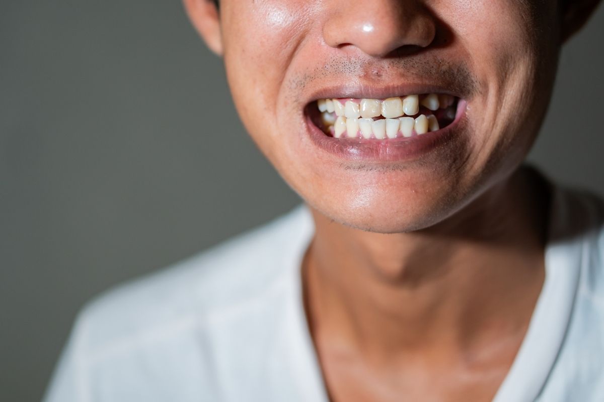 Crowded Teeth vs Misaligned Teeth differences