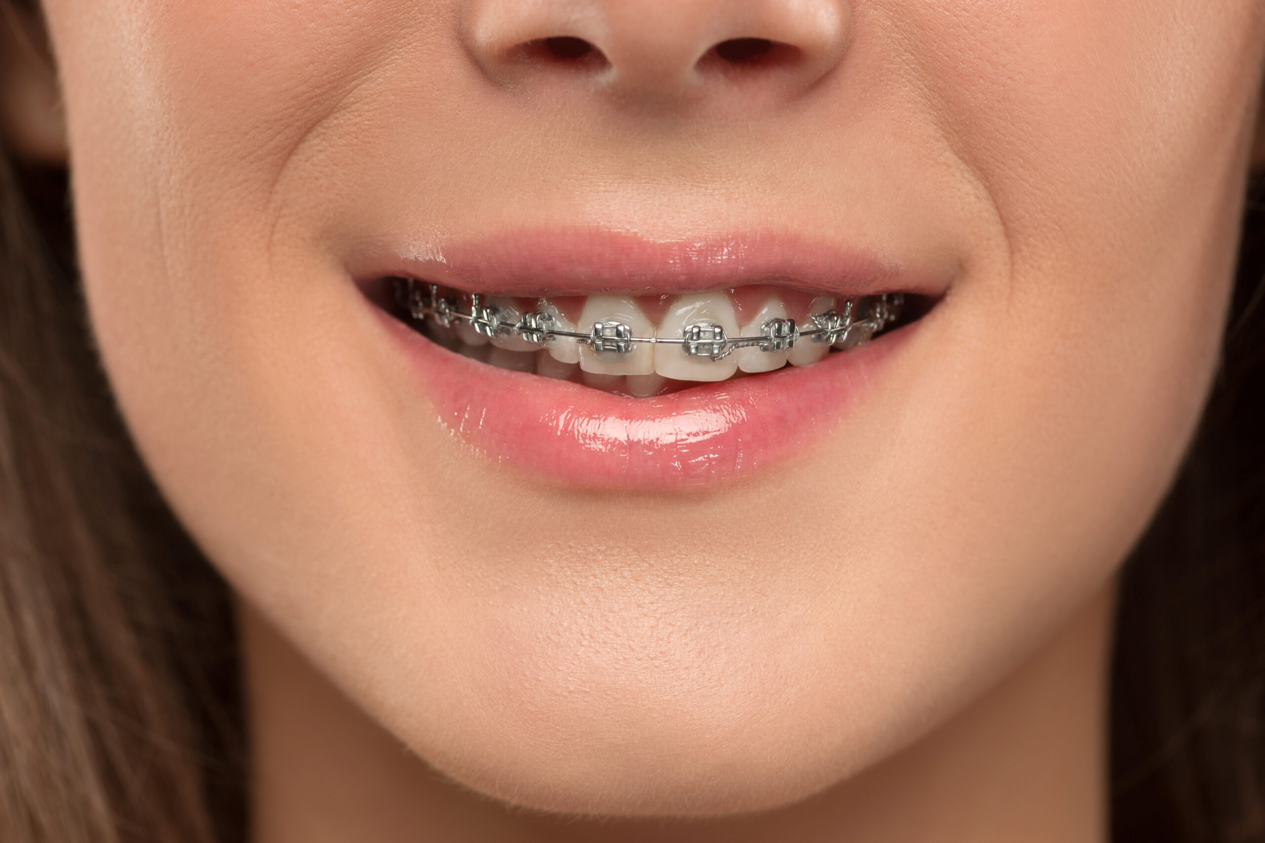 Do I Need Braces? 6 Signs You Should Know