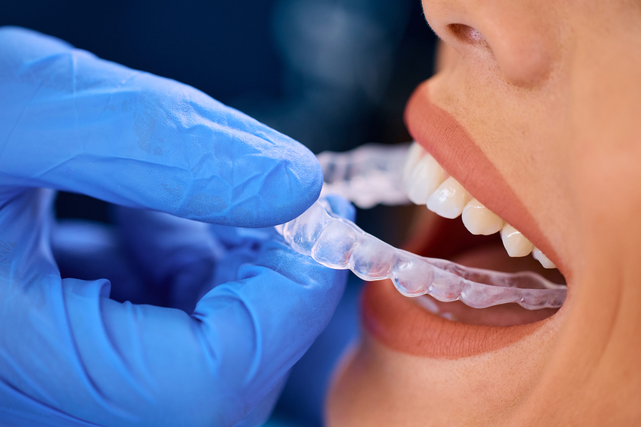 Can Invisalign Damage Your Teeth? Know the Risks